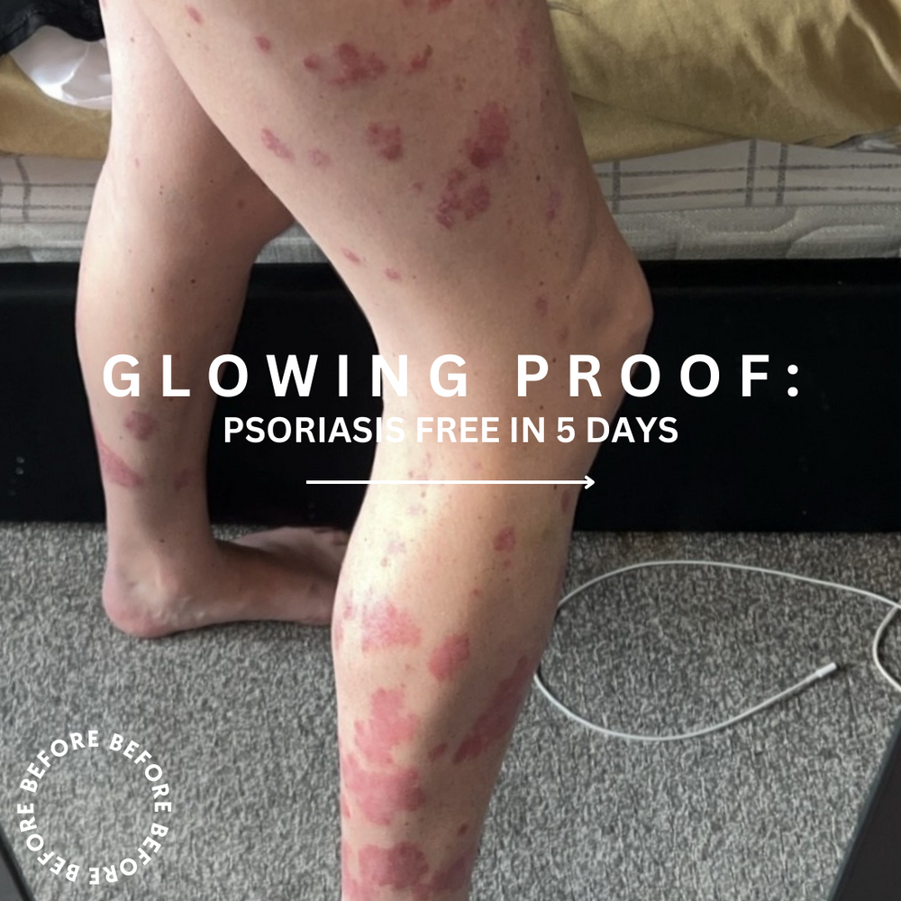 Healing Power of Sea Moss for Psoriasis